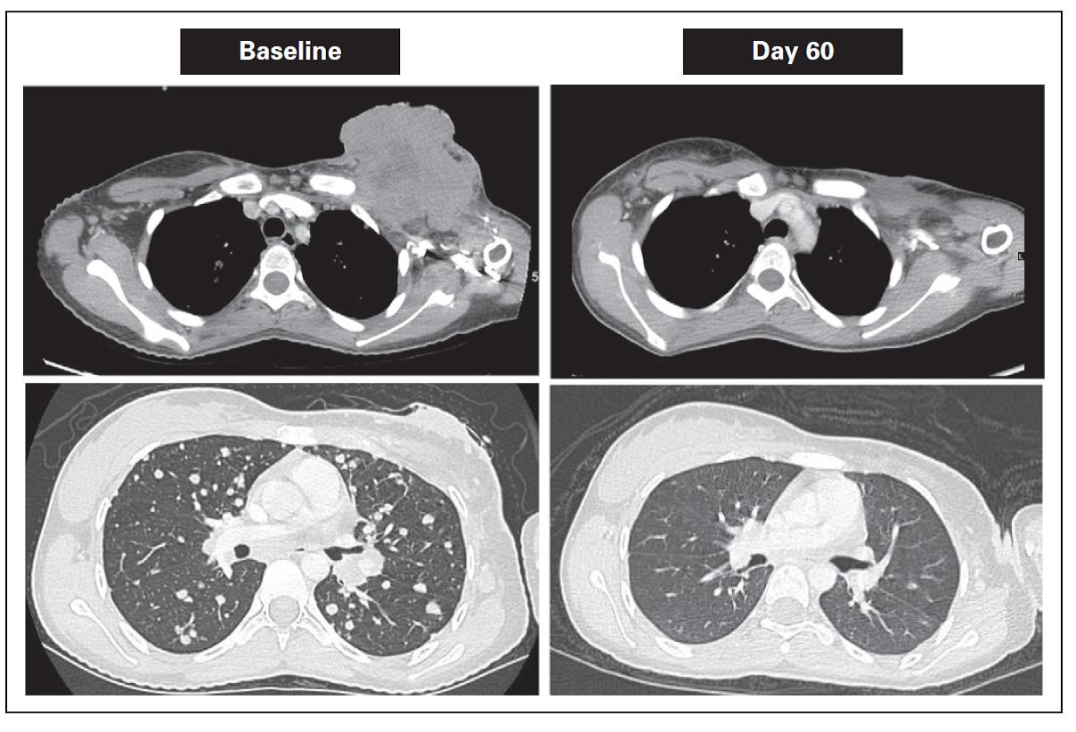 Successful Targeted Therapy of 3